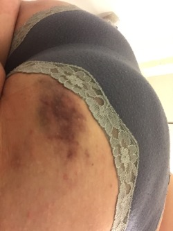 violent-rape-fantasies:  Freshly beaten 💜 🙈——That’s a good bruise.