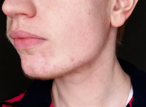 sveriqueer: a little over 10 months on T face acne? not too bad, have had much worse shoulder (&