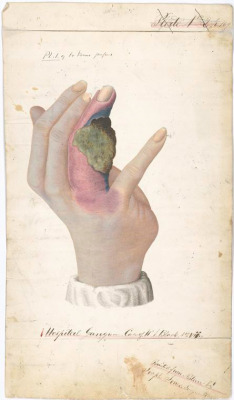 thecivilwarparlor:  Civil War Gangrene Pl. No. 1 of Dr. Jones’ papers : Hospital gangrene : Case of W.J. Black. No. VII / Painted from nature by Joseph Jones. Surgeon PACS. Creator(s): United States Sanitary Commission — Creator  Jones, Joseph, 1833-1896