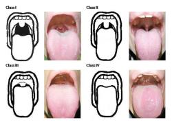 nurse-on-duty:  Mallampati Score/ Mallampati Classification -anesthesiology evaluation to assess ease of intubation - scoring: class 1: entire tonsil clearly visible class 2: upper half of tonsil fossa visible class 3: soft and hard palate clearly visible