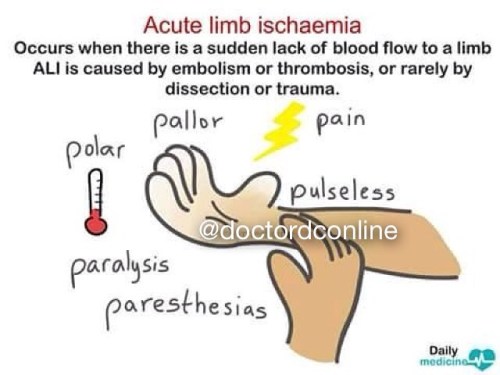 doctordconline:  Acute Limb Ischaemia   #ischaemia #blood #pain #paresthesia #usmle #university #usmlestep1 #usmlestep2 #doctor #doctordconline @doctordconline #nhs #premed #nurse #nursing #paramedic #physiology #pathology #hospital #patient #medstudent