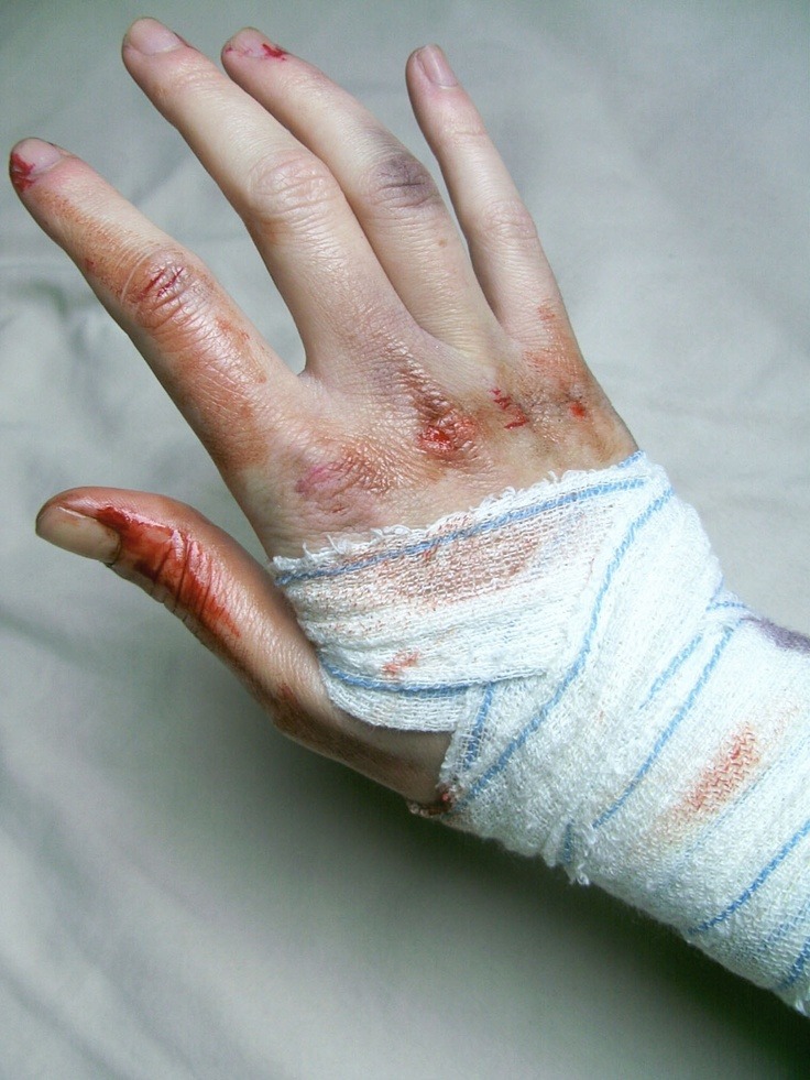 kisskissmollys-lips:Bruised hands collection