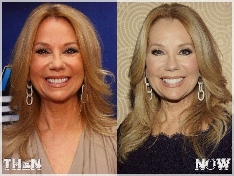 Billy Kane Lee — (via Kathie Lee Gifford Plastic Surgery - New...