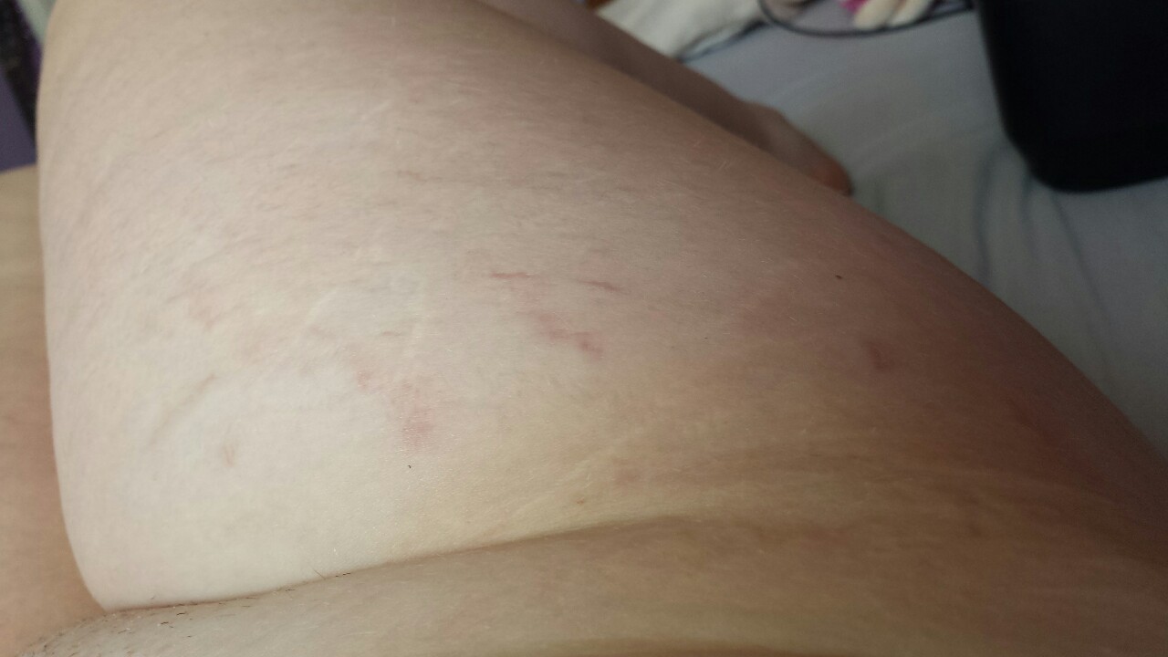 daddyismymrj:  Bits of me I need to learn to love: -My scars. -Stretch marks. -My