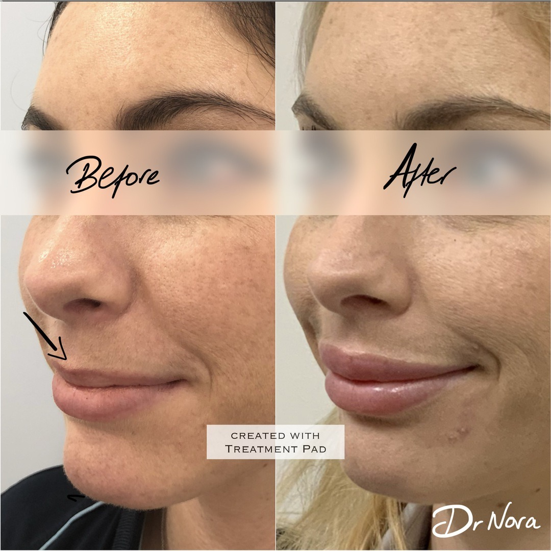 1ml Lip filler 👄Treatment time is around 20 minutes and swelling and bruising is seen straight after settling at around 3-5 days with optimal results at 2 weeks.
If you’re interested in finding out more or to book, head over to drnora.com.
Warning:...