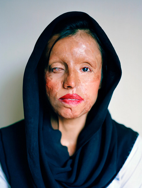 hopeful-melancholy:  In the fall of 2009, I left for Pakistan to start a project around acid and kerosone oil burn survivors. Acid attacks are a common phenomenon in Pakistan, India and Bangladesh as well as other countries in South Asia. Stories about