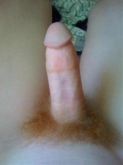 (via foreskin2cut, gingerfever)  The Gomco leaves a particularly satisfying indelible mark on red-heads’ fair skin.