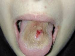 twentymiles:  Infected Tongue Piercing