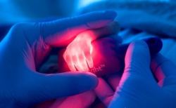 geneticist:  Hand of a premature baby lit to  find the baby’s veins. This allows drugs and fluids  to be administered intravenously. Photographed at  The Sofia Childrens Hospital, Rotterdam, the Netherlands. 