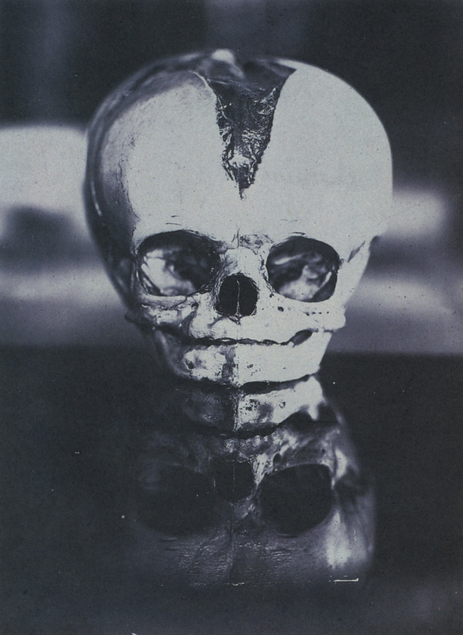 Infant’s Skull with Open Fontanelle unidentified photographer, US ~1910 from: A