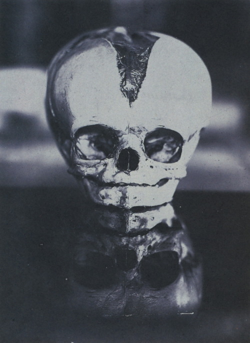 Infant’s Skull with Open Fontanelle unidentified photographer, US ~1910 from: A Morning’s Work: Medical Photographs from the Burns Archive & Collection, 1843-1939