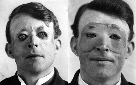 swasticake:  First person to undergo plastic surgery 