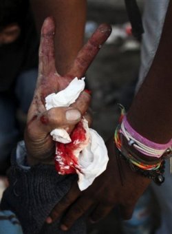 A man makes a peace sign while having his injuries attended to.  From www.arabs48.com 