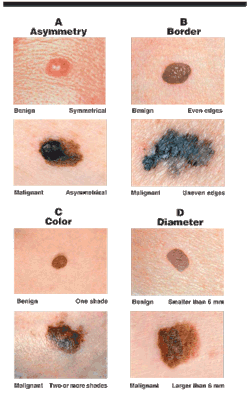 thenotquitedoctor:geneticist:Characteristics of cancerous moles (OP)  Super important! Check your skin before you hop in the shower, and use sunscreen!