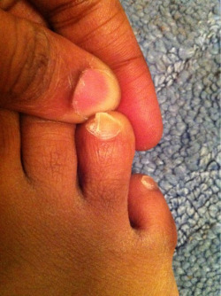 Split toenail after shooting around for a
