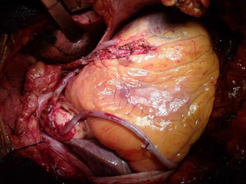 realscrublife:annaslagathor:Today I saw a heart. This is what I do almost everyday. CABGs (Coronary 