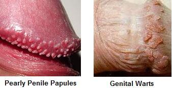 Papules herpes penile vs Difference Between