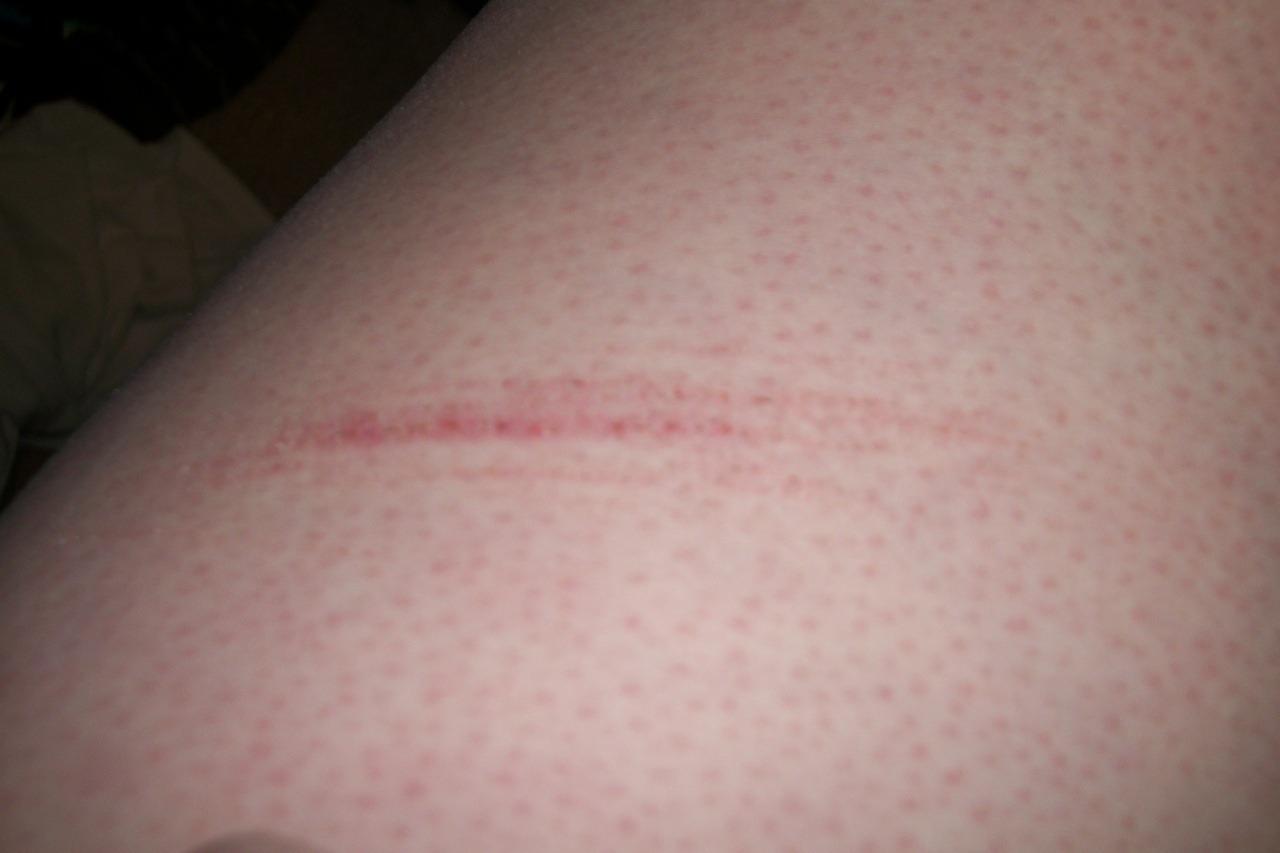 Hurt, Cut, Scars, Love