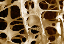 geneticist:Osteoporotic bone