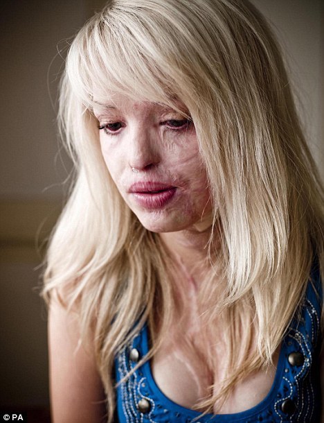 Muslim women acid attacks