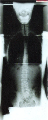 musicspeakswhenwordscannot:  condoravenue:  X-ray of Kurt Cobain’s back.  That’s right, Kurt Cobain has scoliosis. Apparently not that much but it still makes me more badass?  