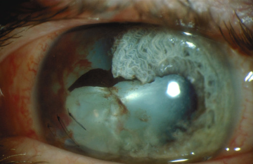 thetemperamentalgoat:Traumatic cataract.The Great Cataract of Kanagawa