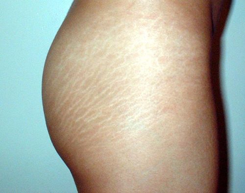 gamervamps:  modernizes:  fuckyeahtouchingthighs:  Remember: stretch marks are normal.  they are so beautiful honestly   Omg these look like ripples in a clear ocean with the sunlight hitting them in the morning