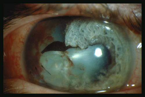 eyedefects:A traumatic cataract results when either a blunt or penetrating object damages the lens.