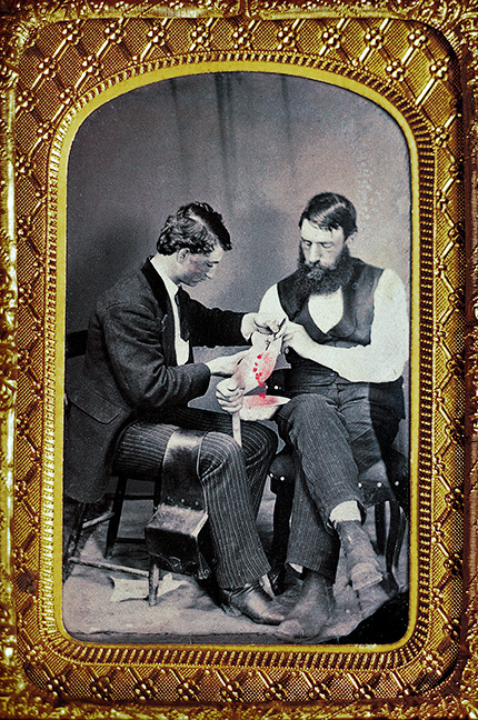 biomedicalephemera:  One of three active bloodletting photographs known to exist, in the Burns Archi