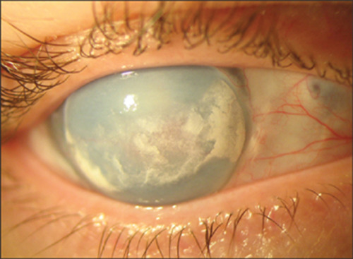 eyedefects: Band keratopathy can be caused by trauma such as surgery. Some eye drops can also cause 