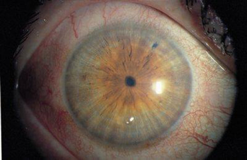 eyedefects: Miosis is constriction of the pupil of the eye to less than or equal to two millimeters.