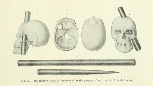 biomedicalephemera:Though a name isn’t noted in the text, the case study notes (no loss of intellige