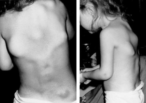 genetic-deformities: Fibrodysplasia ossificans progressiva