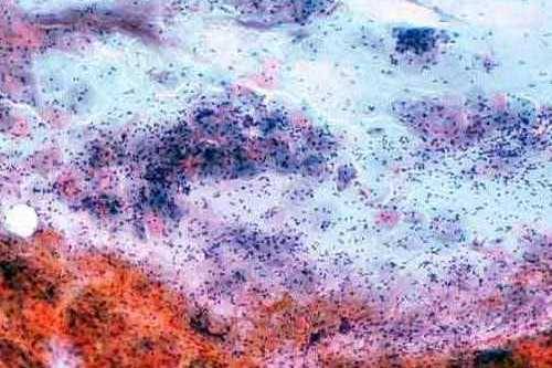 Conventional Pap Smear Cytology.
The Papanicolaou smear, also known as the Pap test is a screening test used in gynecology to detect premalignancy or malignacy in the ectocervix and thus used to prevent cervical cancer.
Georgios Papanikolaou was a...