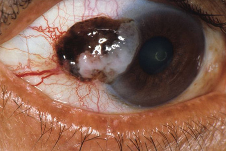 eyedefects: Eye cancer