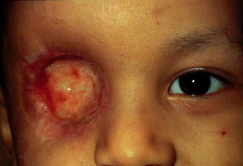 eyedefects: Retinoblastoma after enucleation