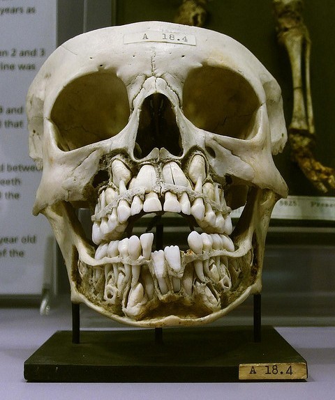 iamadorabloodthirsty:
“ owlpellets:
“ aeromachia:
“ lily-bee:
“ Ever wandered what a child’s skull looks like in the transition between ‘baby’ teeth and adult teeth?
At the Hunterian Museum in London
Source: 22 words
”
well
this is hugely...