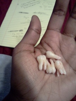 my wisdom teeth! aha. my jaw hurts so fucking