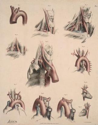 Sir Richard Quain, anomalies of the subclavian artery. Mid-1800s.