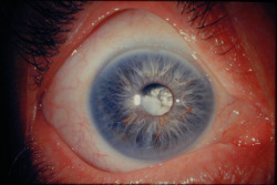 eyedefects:  Subluxated cataract in vitreous