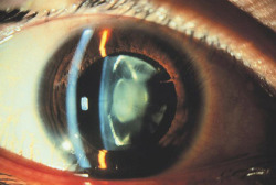 bbllacckk:Congenital cataract
