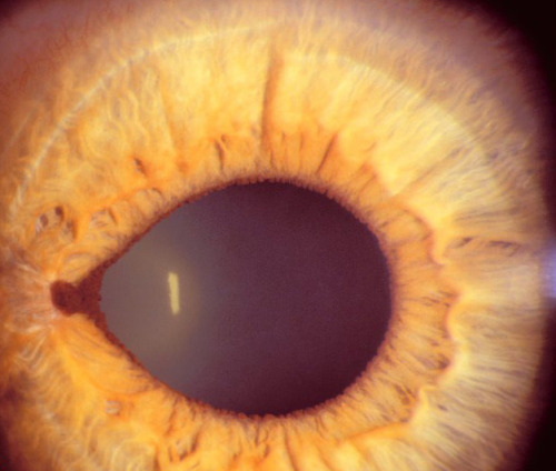 eyedefects:Essential Iris Atrophy