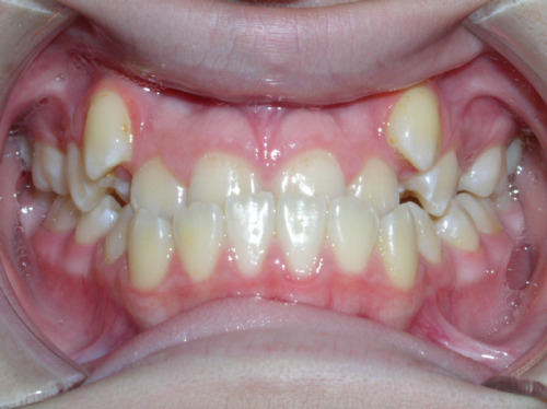 thetemperamentalgoat:High canines are canine teeth (the teeth in the third position from the midline