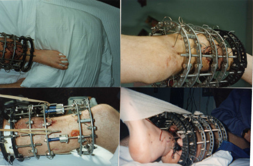 Ilizarov Apparatus/frame.