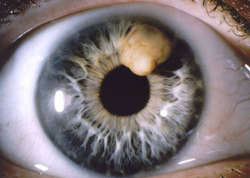  Iris cyst 