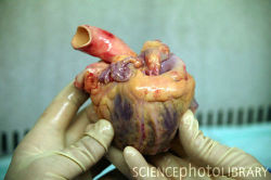 fyeahanatomy:  Human heart prior to dissection in a tissue bank. Parts of a heart taken  from a donor or heart transplant recipient can be used in the treatment  of other patients. The heart is dissected and its aortic, pulmonary and  mitrial valves as