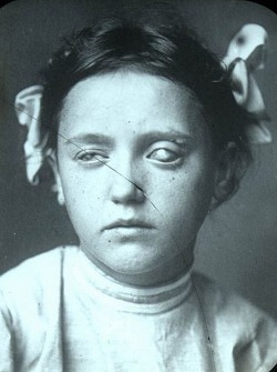 poupeedream: rapeblossom:  Linda Neville Portrait of a blind girl  