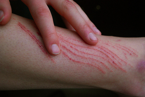 Sex simplesmenteumavagalembranca:   ” As cicatrizes pictures