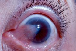 eyedefects:  Pterygium 