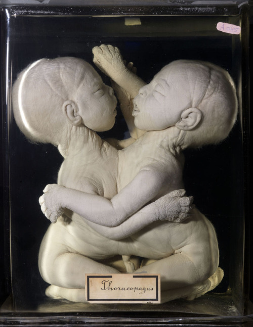 Thoracopagus conjoined twins. Born in early 1900s, live at birth, succumbed after a few hours. Housed in Academisch Medisch Centrum in Amsterdam.